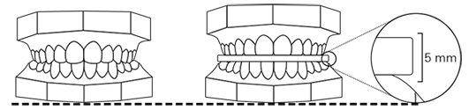 occlusion with sponge