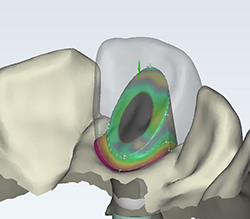 example abutment design top