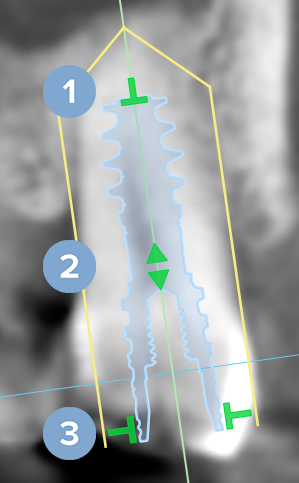 implant